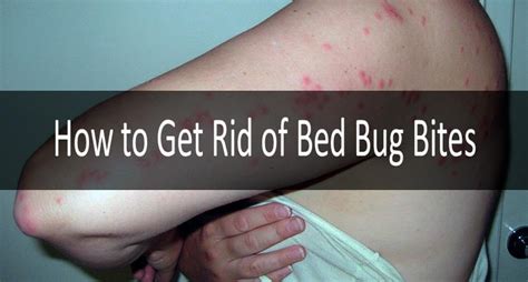 Bed Bug Bites Line