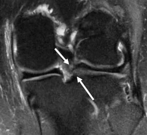 Lateral Meniscus Tear Complex Knee Surgeon Minnesota