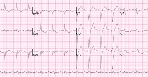 Dr Smiths Ecg Blog Chf Exacerbation With Old Lbbb Is There New