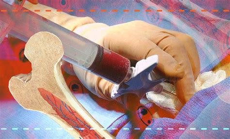 The Bone Marrow Transplant Process Typically Involves Several Steps