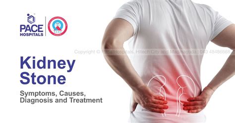 Kidney Stone Causes Symptoms Diagnosis And Treatment