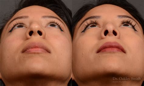 440f rhinoplasty dr oakley smith toronto top surgeon nose job toronto rhinoplasty surgery