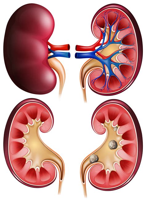 Kidney dysplasia is a condition in which the internal structures of one or both of a fetus' kidneys do not develop normally while in the womb. Kidneys and kidney stones on poster - Download Free ...