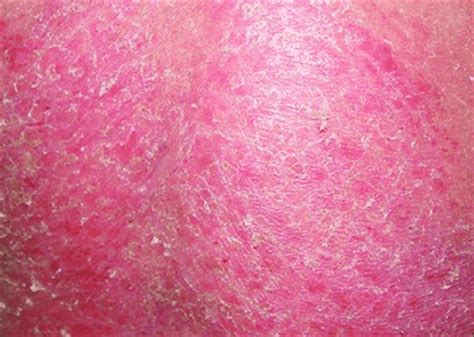 Erythrodermic Psoriasis On The Trunk Of The Patient Download