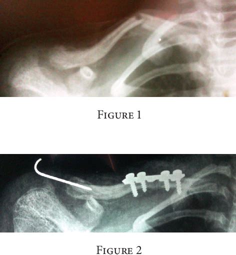 Figure 2 From A Rare Case Of Segmental Clavicle Fracture In An