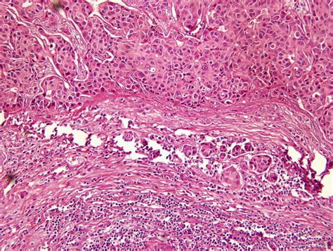 Metastatic Idc In Axillary Lymph Node The Structure Of Lymph Node