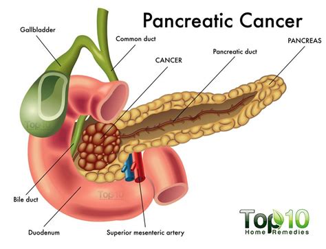 How to detect pancreatic cancer in the early stages? 10 Warning Signs of Pancreatic Cancer that You Must Know ...