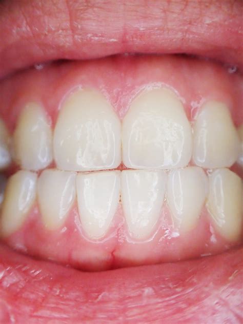Periodontal Disease Why My Gums Are Bleeding Dentistry Blog