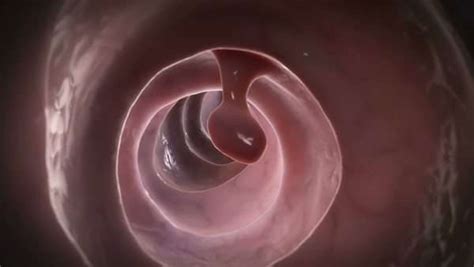 Human Colon Showing A Polyp Animation Polyps Are Outgrowths Of The