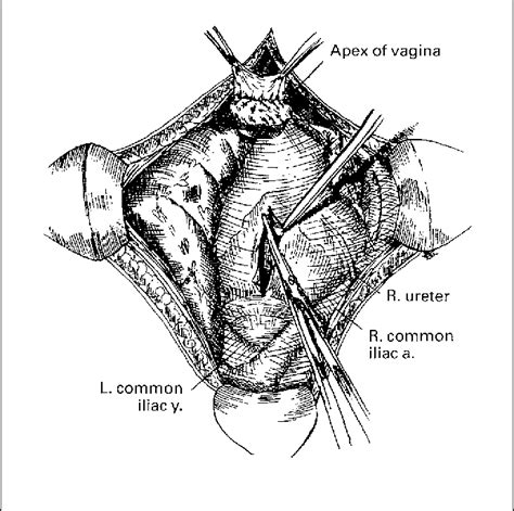 Figure From Abdominal Sacral Colpopexy With Mersilene Mesh Semantic