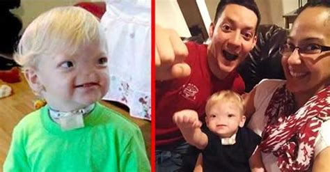 Two Year Old Miracle Baby Born Without A Nose Dies Hrtwarming