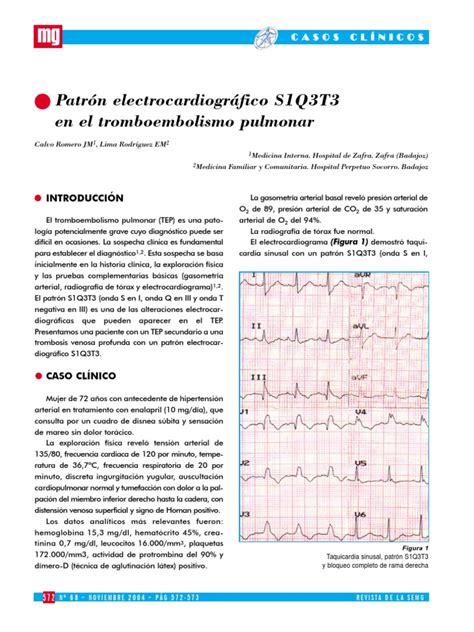 This document follows the previous esc guidelines focusing on the clinical management of pulmonary embolism (pe) published in 2000, 2008, and 2014. ECG en TEP | Fisiología Cardiovascular | Ciencias de la Salud