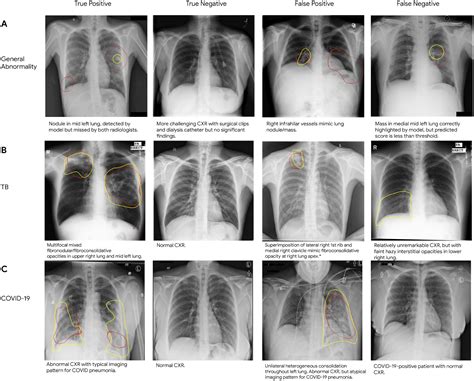 Detecting Abnormal Chest X Rays Using Deep Learning Google Ai Blog