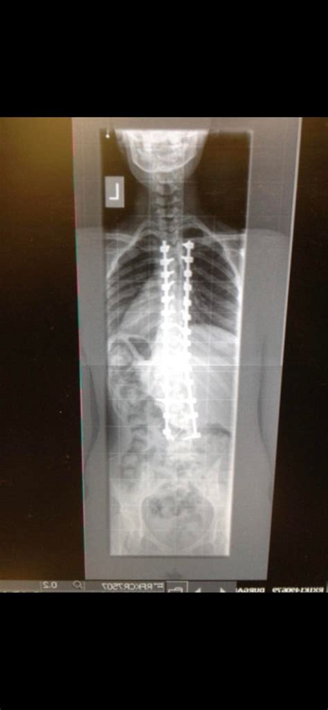 What Did Your Surgeons Say About Thc Prepost Op Rscoliosis