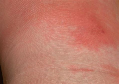 Cellulitis Symptoms Hot Burning Red Tender Skin On Yo