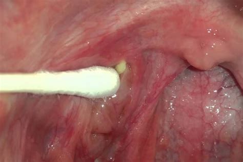 How To Get Rid Of Tonsil Stones Fast Naturally Permanently With Home
