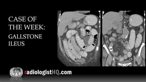 Case Of The Week Gallstone Ileus X Ray And Ct Youtube
