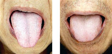 Withered Pale Tongue In Tcm Tongue Diagnosis