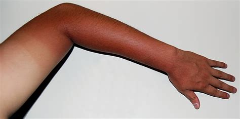 Fileskin Tanning Wikimedia Commons