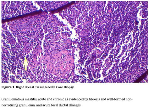 Mastitis is inflammation of the breast or udder, usually associated with breastfeeding. A Case of Chronic Granulomatous Mastitis Caused by ...