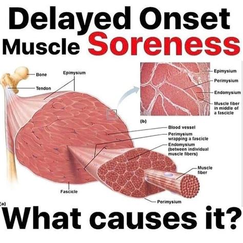 Delayed Onset Muscle Soreness Myoactive