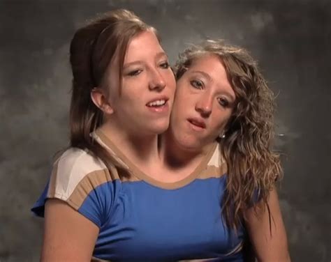 Conjoined Twins Abby And Brittany Sex