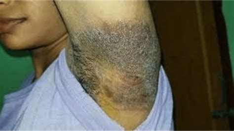 Ringworm What Is It Symptoms And Signs