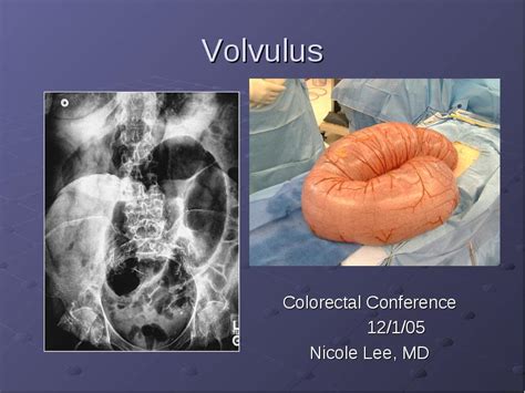 Nicole lee lives on saint paul st in baltimore, maryland. Volvulus Colorectal Conference