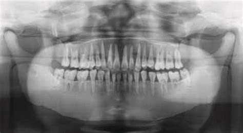 Radiographically, the nasal fossae appear as vertically oblong radiolucent structures bounded by bone. Dental Radiography Head Phantom - PH-47 - Kyoto Kagaku