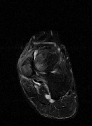 Accessory Navicular Syndrome Image Radiopaedia Org