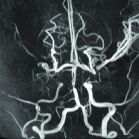 Magnetic Resonance Angiogram Showing Abrupt Cutoff Of Distal Right