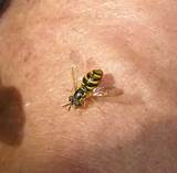 Pictures of Yellow Jacket Wasp Sting