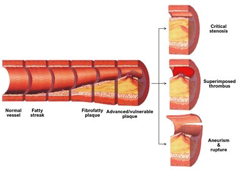 Pathophysiology Of Atherosclerosis Pathology