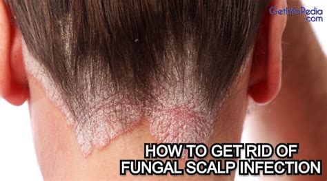 How To Get Rid Of Fungal Scalp Infection Getinfopedia