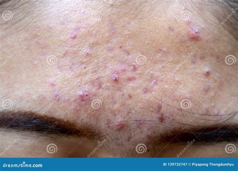 Backgrounds Of Lesions Skin Caused By Acne On The Face Stock Image