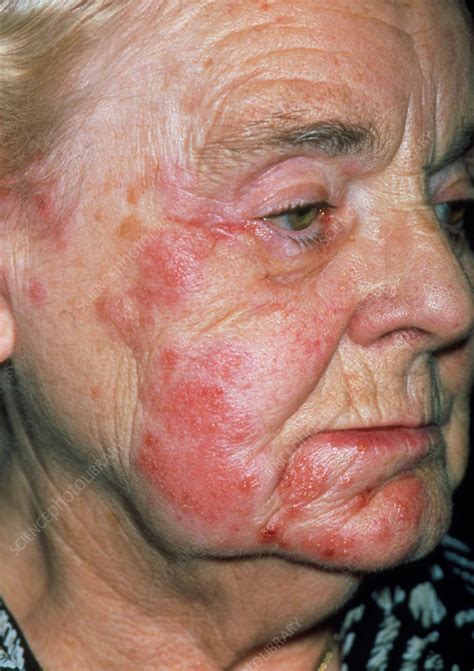 Herpes skin rash outbreaks usually affect the mouth or genitals, but they can appear anywhere on the body. Herpes zoster rash on an elderly woman's face - Stock ...