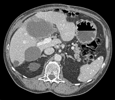 Gallbladder Cancer Liver Case Studies Ctisus Ct Scanning