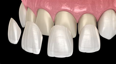 pros and cons of porcelain veneers big smiles dental