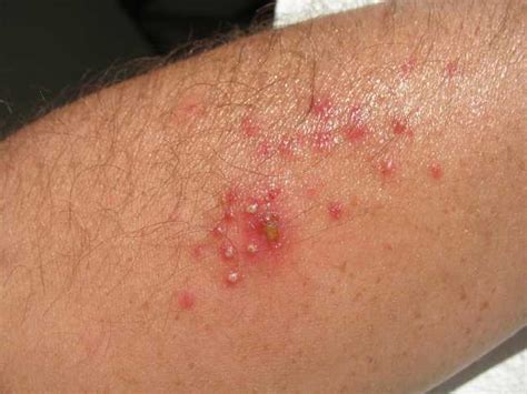 Bacterial Infection On Skin Pictures Photos