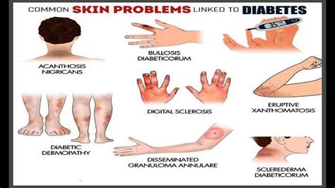Common Skin Problems Linked To Diabetes Youtube