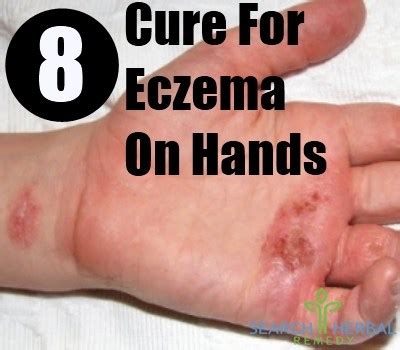 People have a misconception that this is a pediatric condition but a study says that even seniors are vulnerable to it. 8 Cure For Eczema On Hands - How To Cure Eczema | Search ...