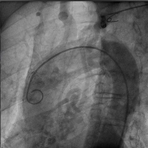 An Aortic Angiogram Shows A Tortuous Vessel Originating From The Aortic