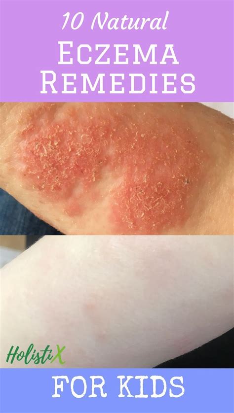 Holistix Health Blog — Coming Soon Allergy Remedies Natural Eczema