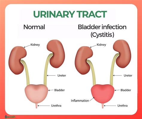 Urinary Tract Infection Cystitis Bladder Highlighted On The My Xxx