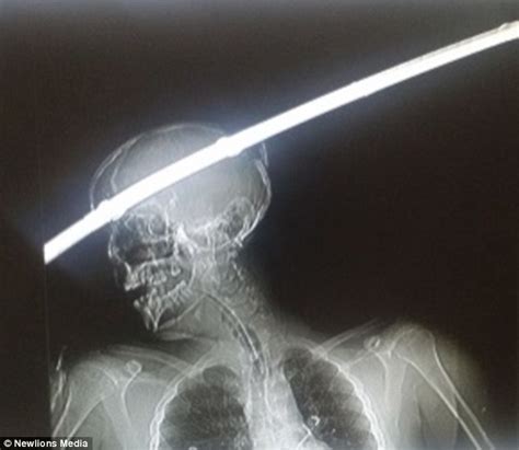 Indian Man Survives Being Impaled By An Iron Rod That Went Through His