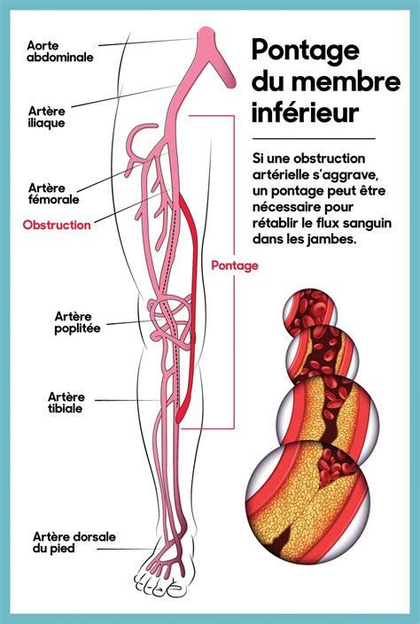 Chirurgie De Pontage De La Jambe L’hôpital D’ottawa