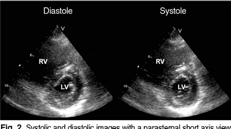 [pdf] Role Of Echocardiography In Patients With Acute Pulmonary Thromboembolism Semantic Scholar