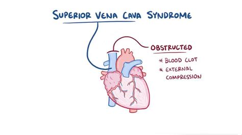 Superior Vena Cava Syndrome Video And Anatomy Osmosis
