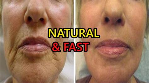 How Can I Get Rid Of Wrinkles Around My Lips