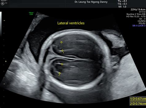 Normal Lateral Ventricles Ultrasound